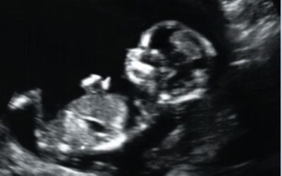 Det Etiske Råds udtalelse og anbefaling vedrørende sene aborter